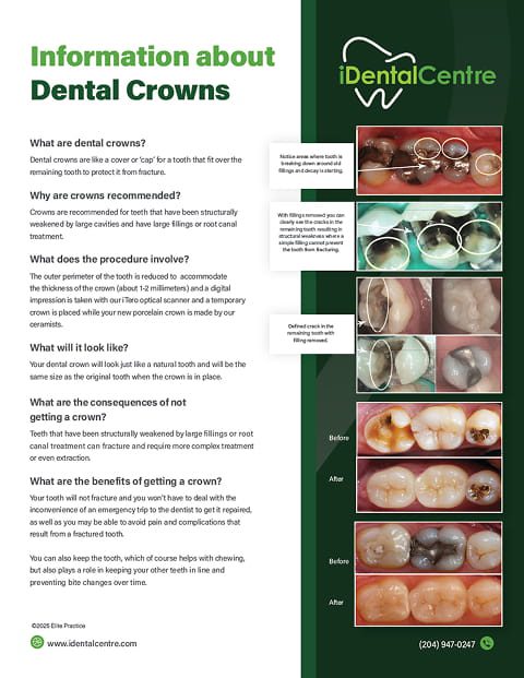 Dental-Crowns